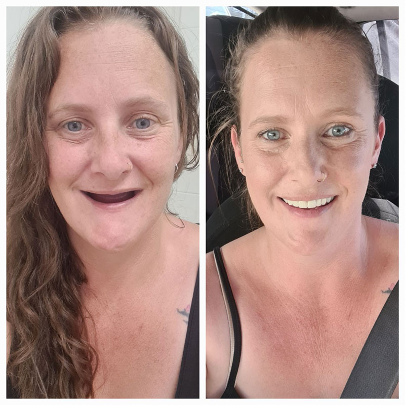 Full Dentures Noyce Denture Clinic Services Christies Beach Adelaide