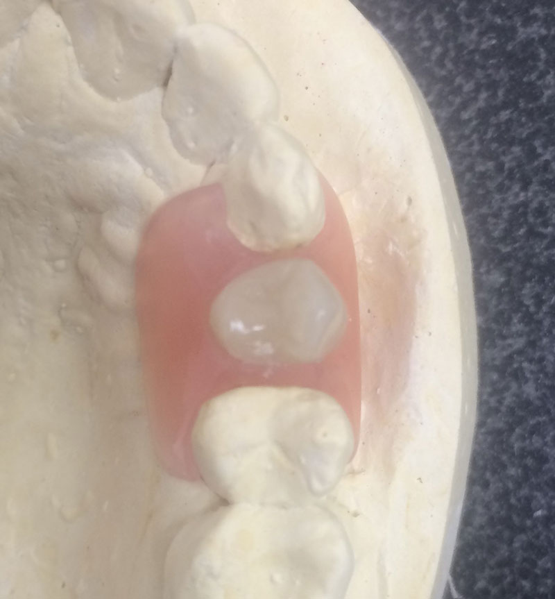 Partial denture Dentures Noyce Denture Clinic Christies Beach Adelaide